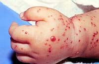 staph infection treatment at home