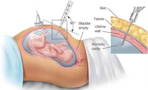 prenatal genotype testing in nigeria/amniocentesis