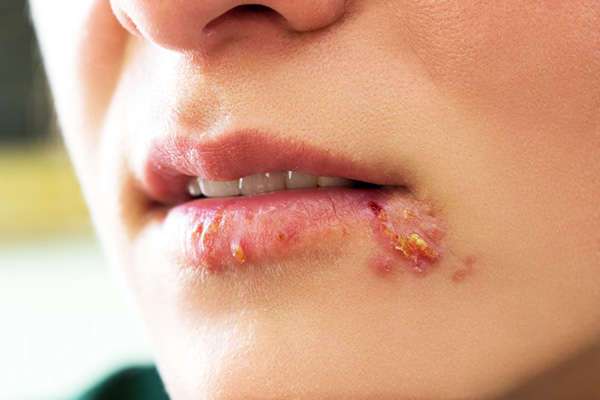 how to get rid of a cold sore scab