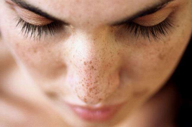 how to remove dark spots on face overnight